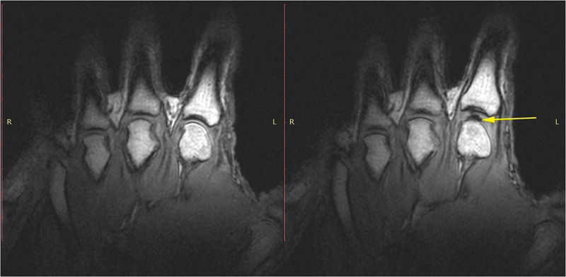 Research from a 2015 study showing the joint before (left) and after (right) knuckle cracking.